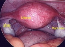 Laparoscopy of normal pelvis