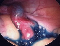 Blue dye shows normal fallopian tube