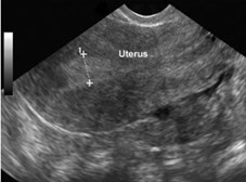 Pelvis ultrasound